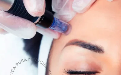 Descubre el Poder del Dermapen en Málaga y Mijas: Revoluciona Tu Piel